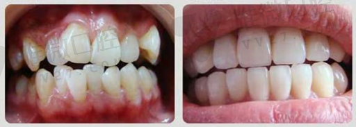各种不同材料假牙的区别,假牙用的什么材料(图1)
